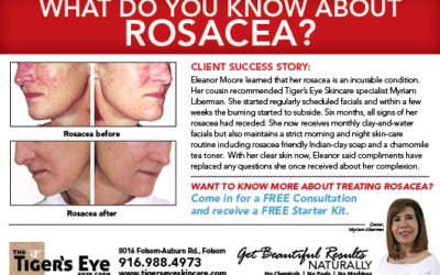 Rosacea and how TigersEyeSkincare products can help!